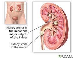 Picture of kidney stones