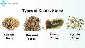 Types of kidney stones