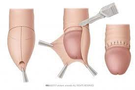 picture of the circumcision procedure