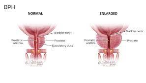 picture of normal and enlarged prostate